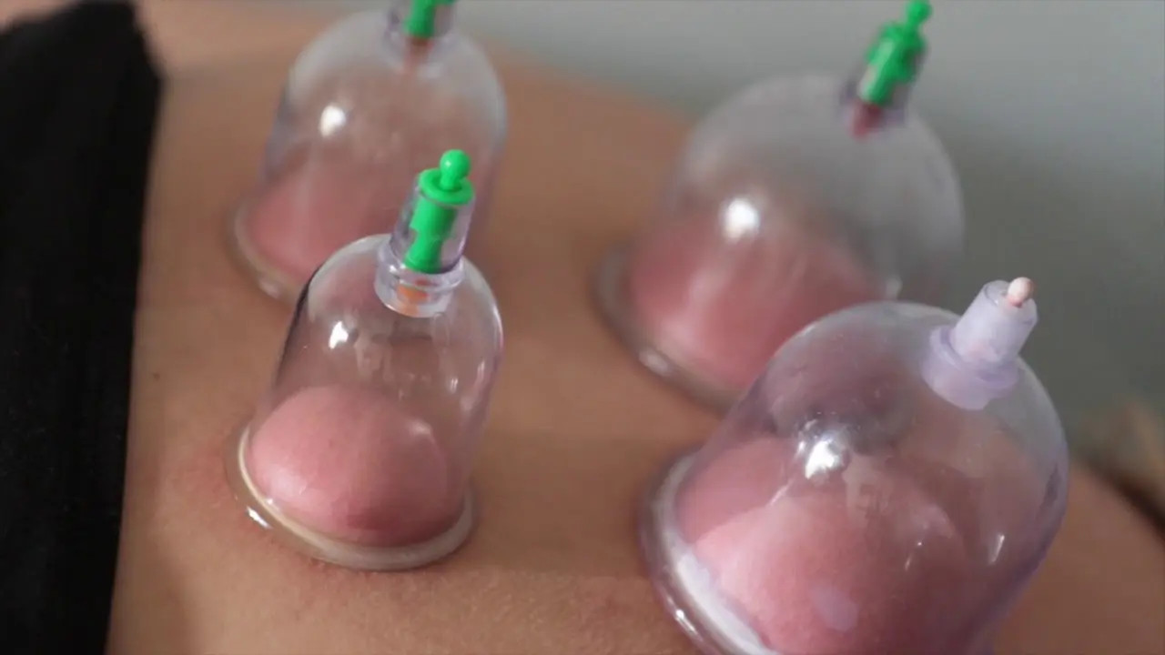 Coining Therapy: Tradition, Science, Benefits, and Modern Applications